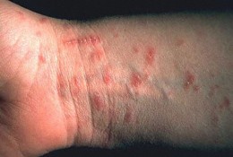 scabies